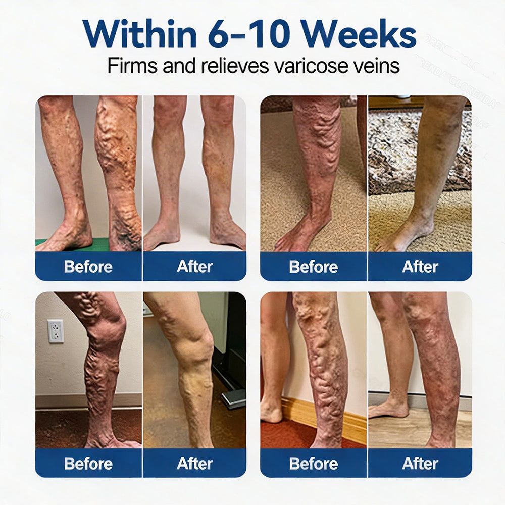 𝐏𝐮𝐫𝐞𝐥𝐨𝐫𝐚® 𝐃𝐢𝐨𝐬𝐦𝐢𝐧 & 𝐀𝐞𝐬𝐜𝐢𝐧 𝐕𝐞𝐢𝐧 𝐂𝐨𝐧𝐭𝐨𝐮𝐫 𝐌𝐢𝐜𝐫𝐨𝐧𝐞𝐞𝐝𝐥𝐞 𝐏𝐚𝐭𝐜𝐡 🌿𝟕-𝐃𝐚𝐲 𝐕𝐢𝐬𝐢𝐛𝐥𝐞 𝐑𝐞𝐬𝐮𝐥𝐭𝐬 𝐟𝐨𝐫 𝐕𝐚𝐫𝐢𝐜𝐨𝐬𝐞 𝐕𝐞𝐢𝐧𝐬 - 𝐀𝐝𝐯𝐚𝐧𝐜𝐞𝐝 𝐇𝐞𝐫𝐛𝐚𝐥 𝐁𝐥𝐞𝐧𝐝 𝐓𝐚𝐫𝐠𝐞𝐭𝐬 𝐒𝐩𝐢𝐝𝐞𝐫 𝐕𝐞𝐢𝐧𝐬 & 𝐑𝐞𝐥𝐢𝐞𝐯𝐞𝐬 𝐇𝐞𝐚𝐯𝐲, 𝐓𝐢𝐫𝐞𝐝 𝐋𝐞𝐠𝐬🦵