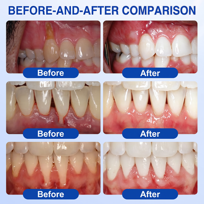👨‍⚕️🦷𝑷𝒖𝒓𝒆𝒍𝒐𝒓𝒂® GumRevive periodontal repair gel